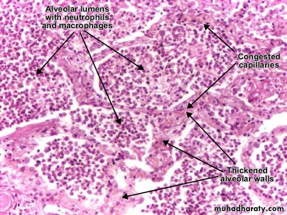 Pneumonia