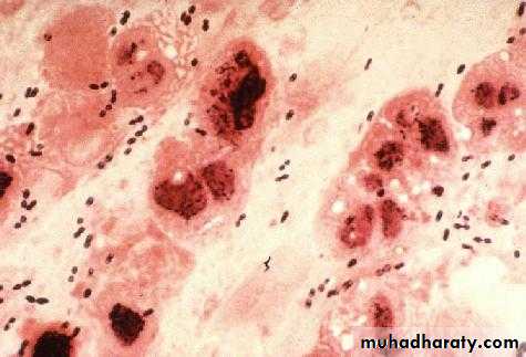 Pneumonia