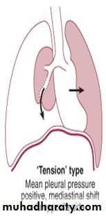 Pneumothorax