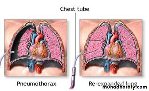 Pneumothorax