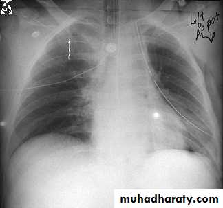 Pneumothorax