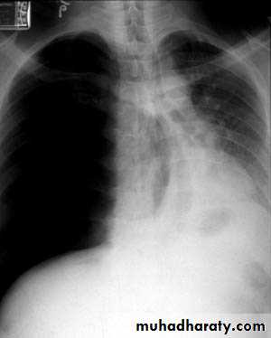 Pneumothorax