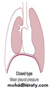 Pneumothorax