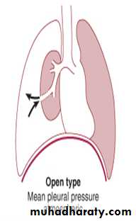 Pneumothorax