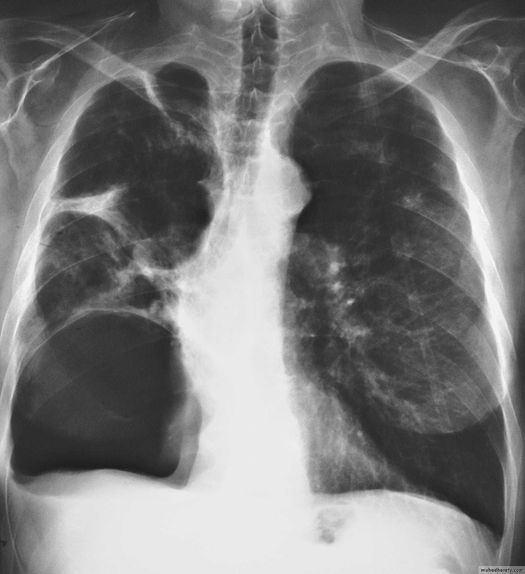 Pneumothorax