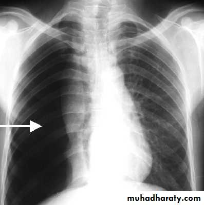 Pneumothorax