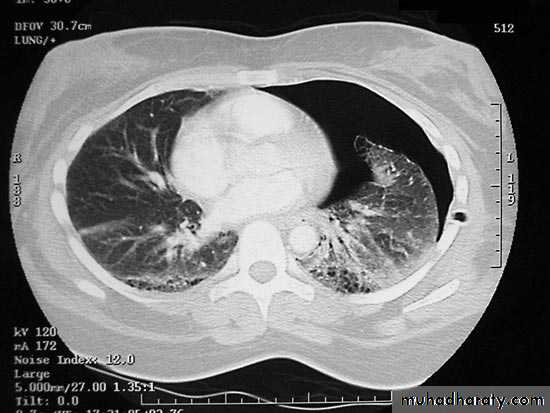 Pneumothorax