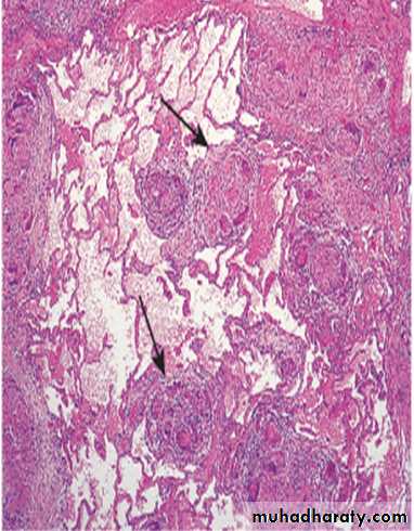Interstitial Lung Diseae