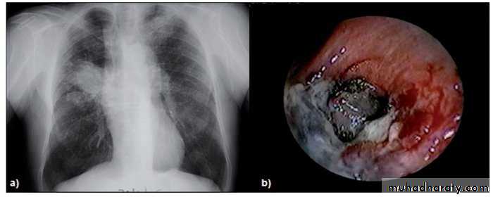 Interstitial Lung Diseae