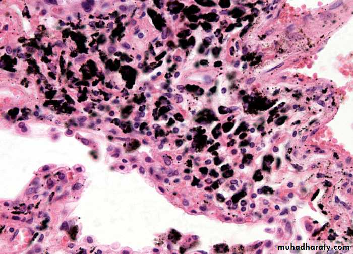 Interstitial Lung Diseae