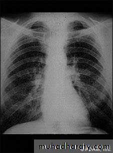 Interstitial Lung Diseae