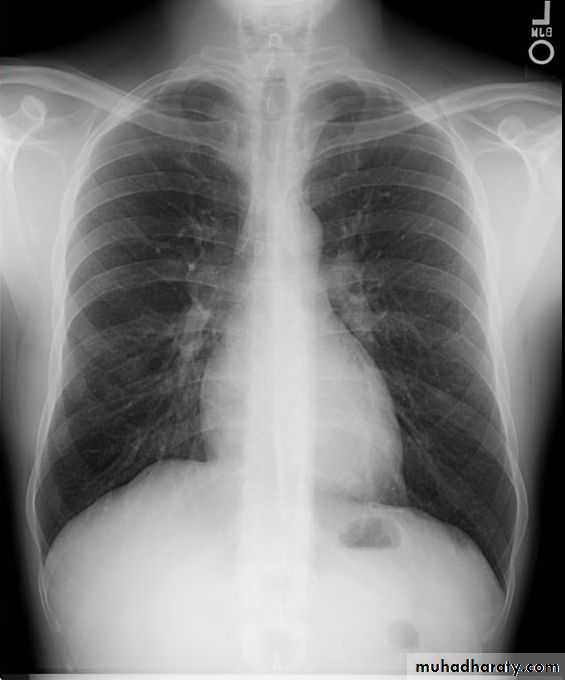 Interstitial Lung Diseae
