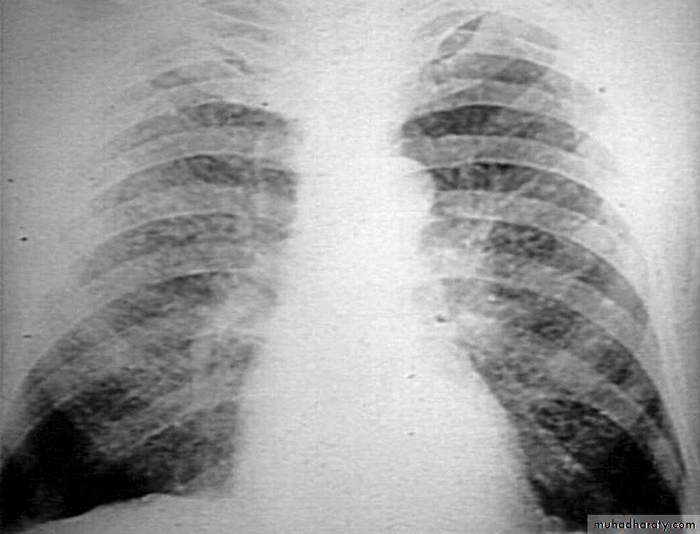 Interstitial Lung Diseae