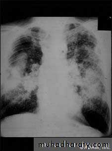 Interstitial Lung Diseae