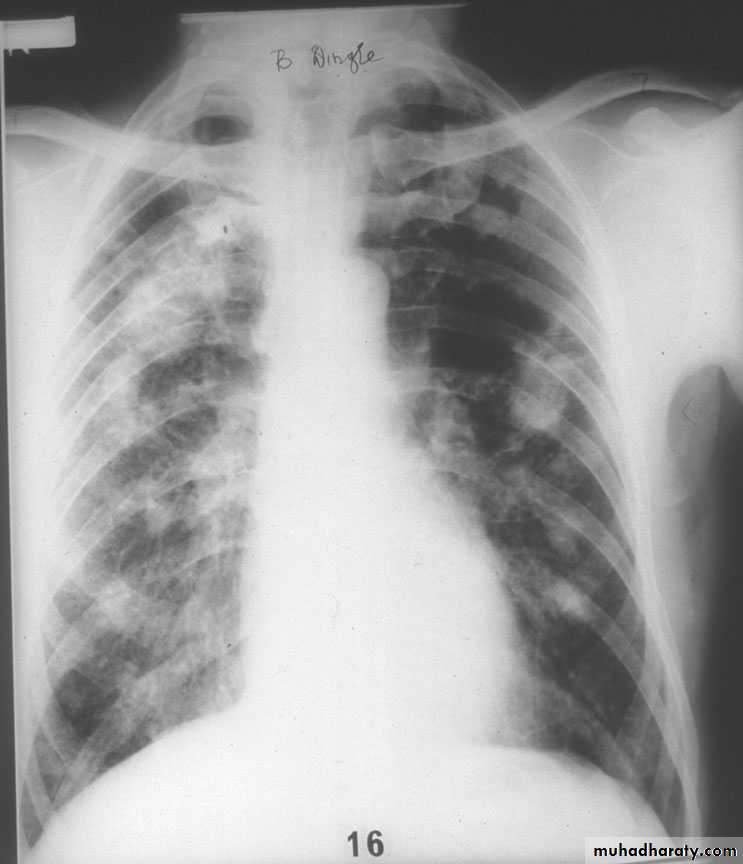 Interstitial Lung Diseae