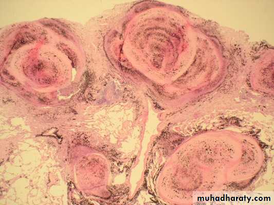 Interstitial Lung Diseae
