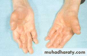 Interstitial Lung Diseae