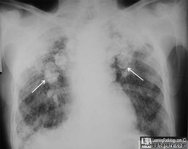 Interstitial Lung Diseae