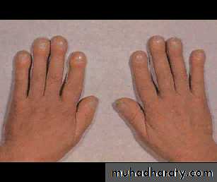 Interstitial Lung Diseae