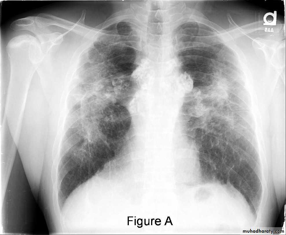 Interstitial Lung Diseae