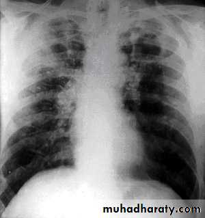 Interstitial Lung Diseae