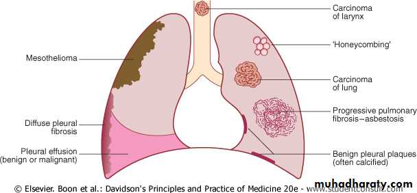 Interstitial Lung Diseae