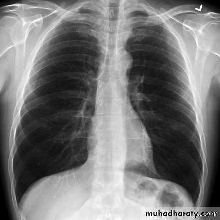 Interstitial Lung Diseae