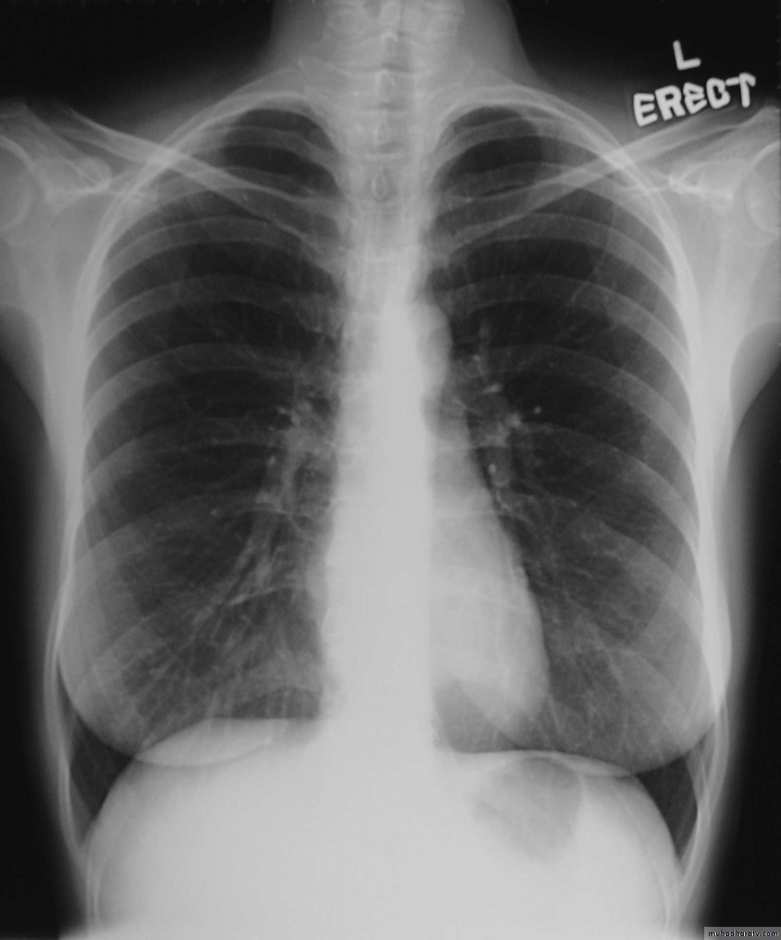 Interstitial Lung Diseae
