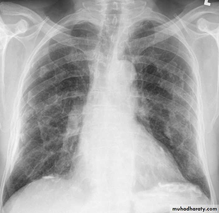 Interstitial Lung Diseae