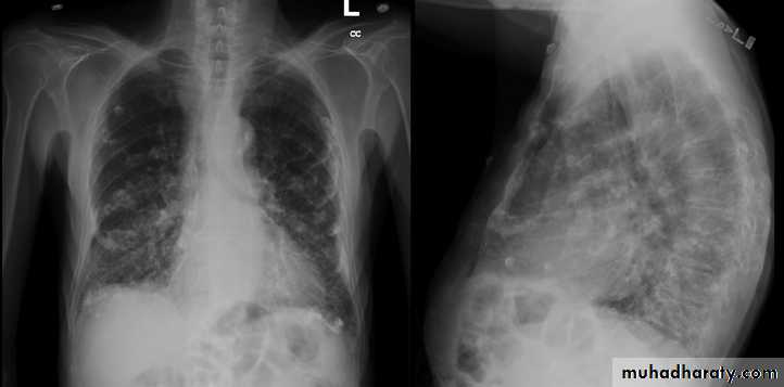 Interstitial Lung Diseae