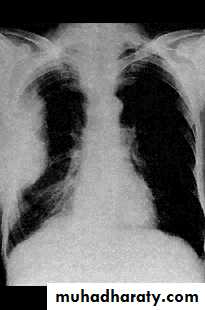Interstitial Lung Diseae