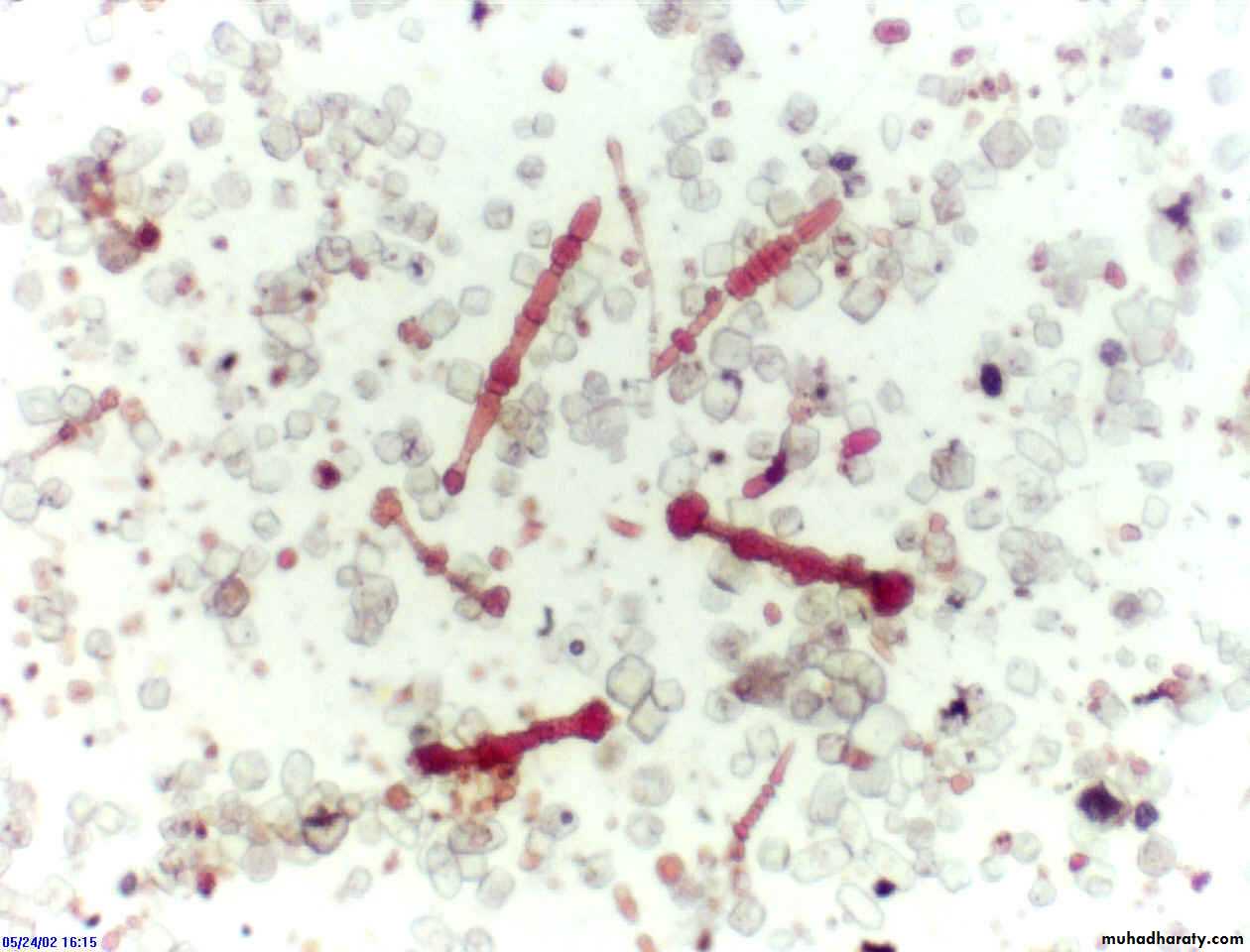 Interstitial Lung Diseae