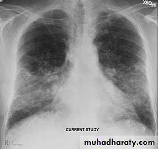 Interstitial Lung Diseae