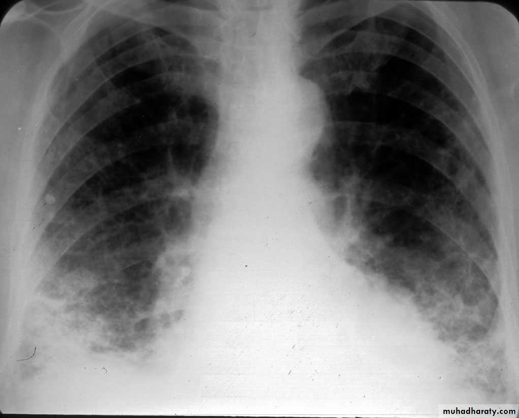 Interstitial Lung Diseae