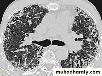 Interstitial Lung Diseae