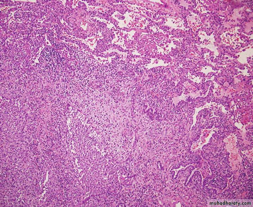 Interstitial Lung Diseae