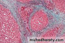 Interstitial Lung Diseae