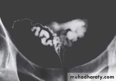 MALE INFERTILITY