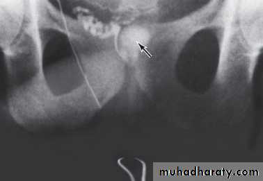 MALE INFERTILITY