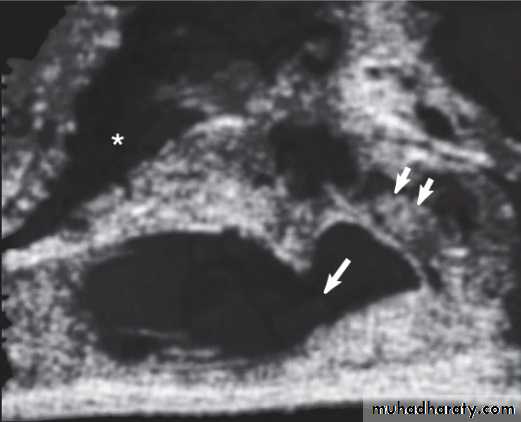 MALE INFERTILITY