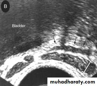 MALE INFERTILITY
