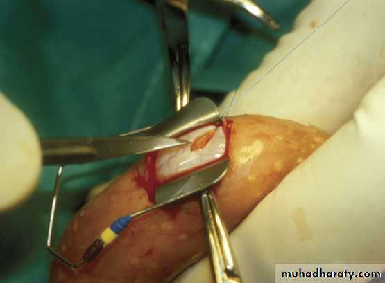 MALE INFERTILITY