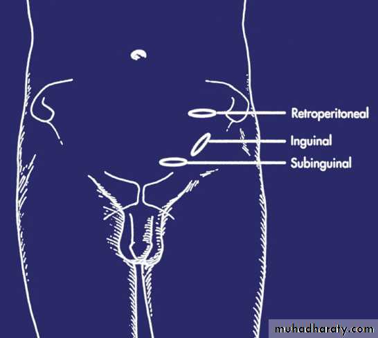 MALE INFERTILITY