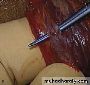 MALE INFERTILITY