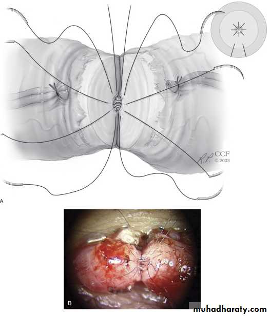MALE INFERTILITY
