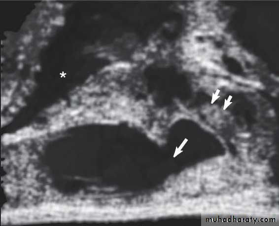 MALE INFERTILITY