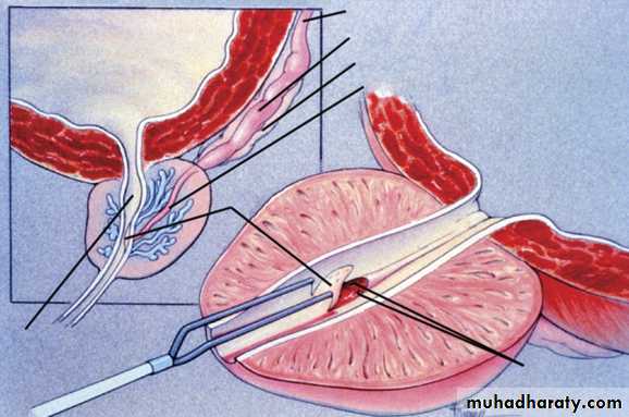 MALE INFERTILITY
