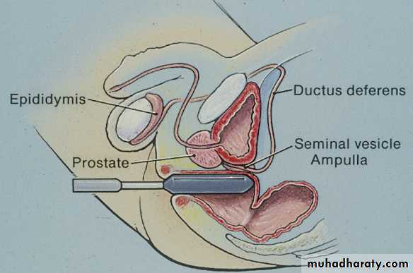 MALE INFERTILITY