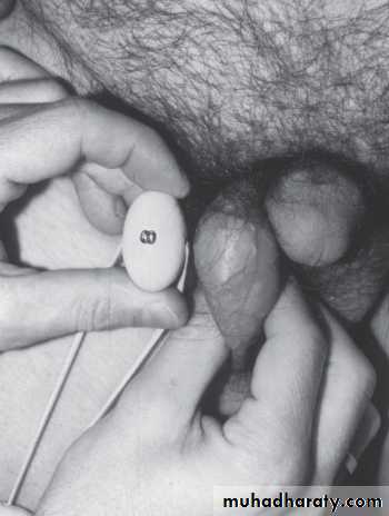 MALE INFERTILITY
