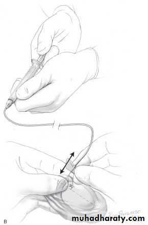 MALE INFERTILITY
